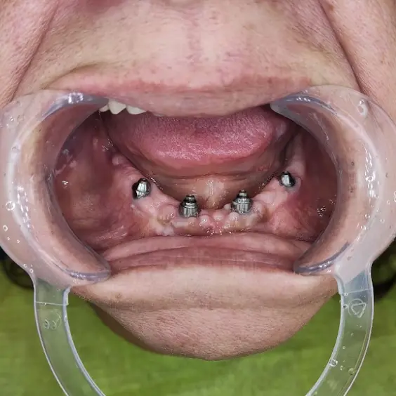 all on 4 ugradnja zubnih implanata najbolji zubni implanti